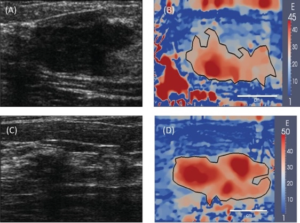 Use of ultrasound based elasticity imaging for tumor detection
