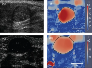 Use of ultrasound based elasticity imaging for tumor detection