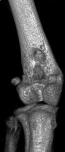 CT image of a mouse with metastatic breast cancer to the femur.