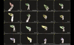 The goal of this project was to explore bone regeenration at a fundamental level using a mouse digit regeneration model. Mouse digit regeneration is plane-specific. If less than one-third of the digit tip is amputated, regeneration of the digit will occur. IN contrast, if over two-thirds of the digit is amputated, digit regeneration will not occure. The current experiment temporally and spatially compared bone re-growth between a regenerating and non-regenerating digit using μCT imaging. Removal of 12% of the bone resulted in regrowth of the bone (intact-Day 105). Interestingly, bone underwent resorption at day 14 post-amputation before regrowth occurred. Removal of 84% of bone resulted in little to no regrowth of the digit (Amputation-Day 105 Non-regenerating). This work is being conducted by Drs. Connie S. Chamberlain, Matthew A. Halanski, William L. Murphy, Xin Sun, Ray Vanderby, and students Lia Woods and Katie Swift.